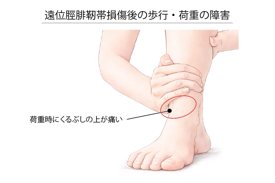 遠位脛腓靭帯損傷後の歩行・荷重の障害