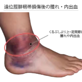 足首の捻挫が治らない原因は？遠位脛腓靭帯損傷（ハイアンクルスプレイン）をわかりやすく解説