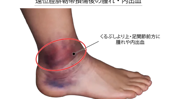 足首の捻挫が治らない原因は？遠位脛腓靭帯損傷（ハイアンクルスプレイン）をわかりやすく解説