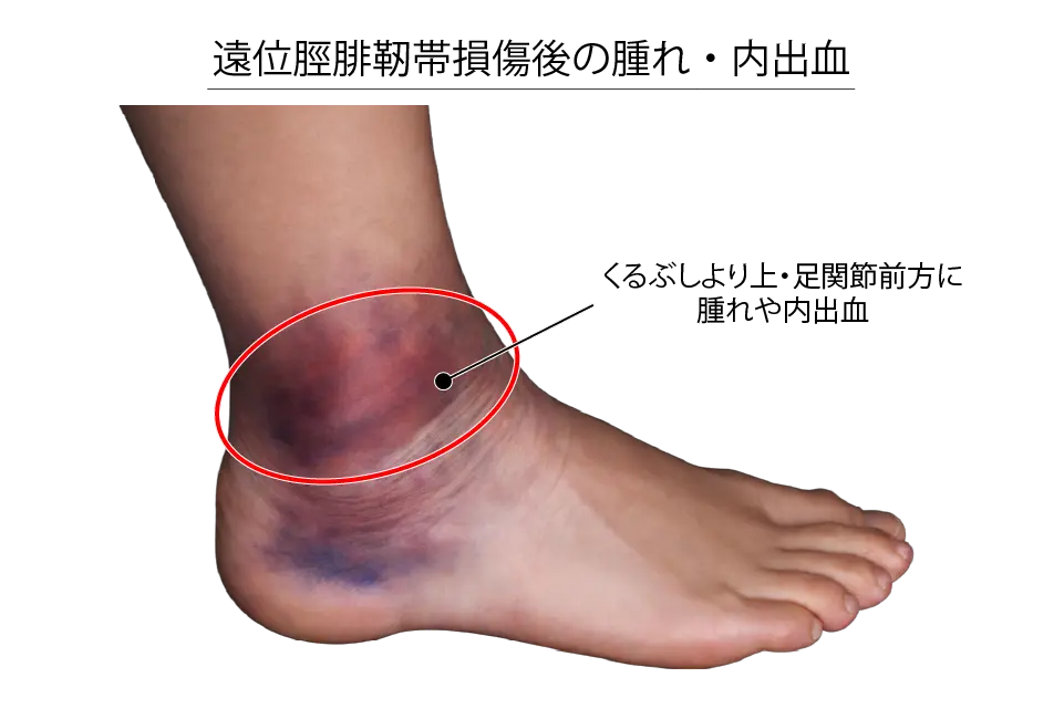 遠位脛腓靭帯損傷後の腫れや内出血