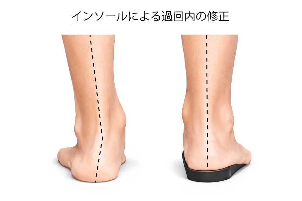 インソールによる過回内の修正