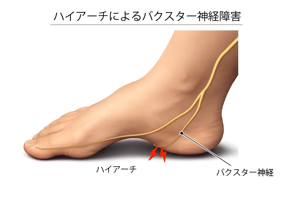 ハイアーチによるバクスター神経障害