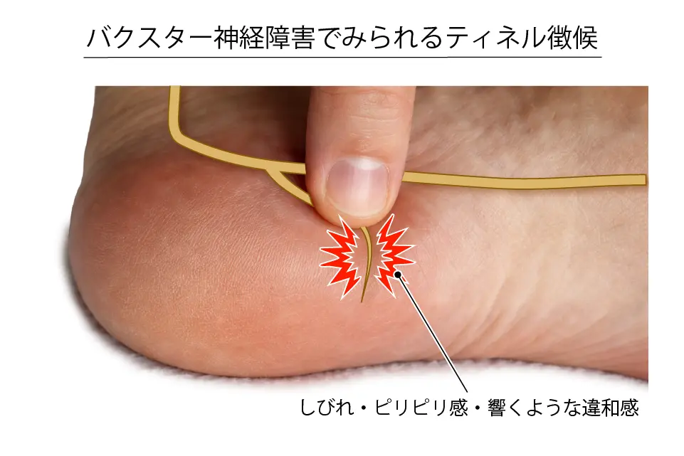バクスター神経障害の痛みの出方
