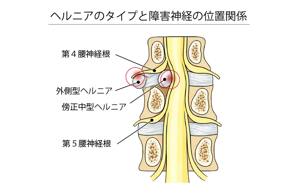 ヘルニアのタイプと障害神経の位置関係