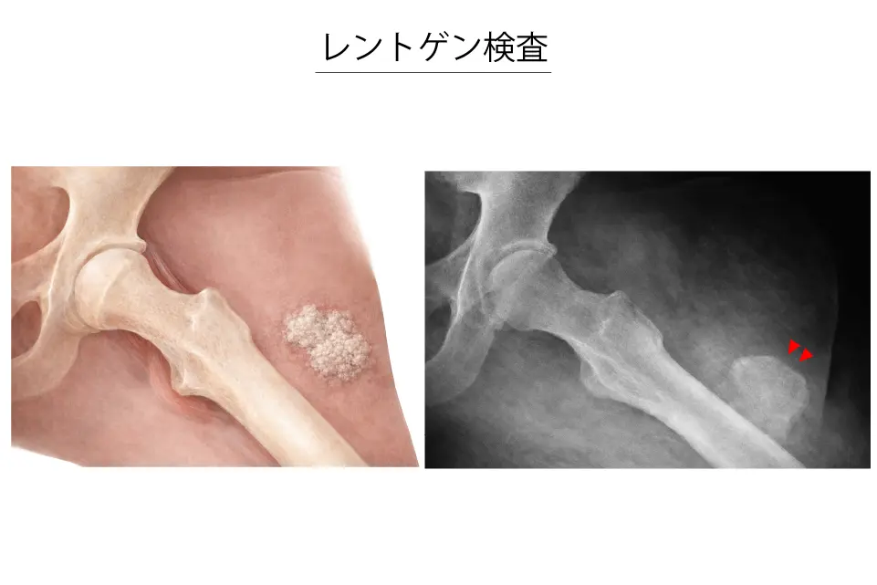 骨化性禁煙のレントゲン検査