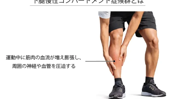 走るとスネの前側が痛む原因は？下腿慢性コンパートメント症候群について