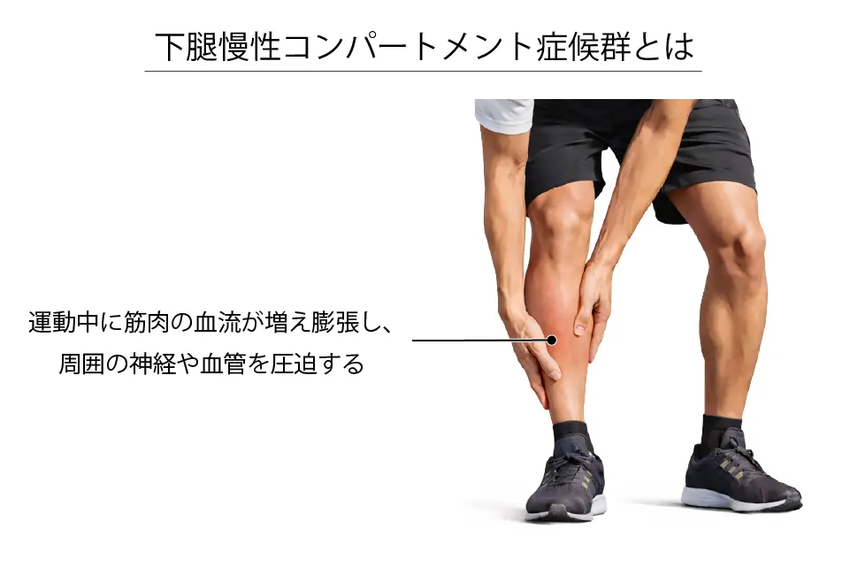 下腿慢性コンパートメント症候群とは