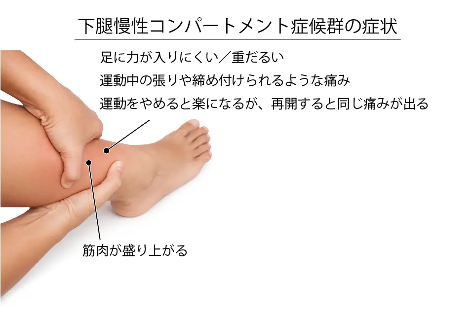 下腿慢性コンパートメント症候群の症状