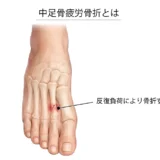 【金沢市】中足骨疲労骨折と診断されたアスリートへ｜休むべき？運動は？復帰までの正しい対処法