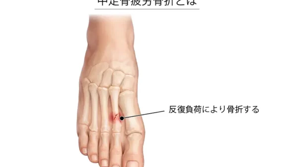 【金沢市】中足骨疲労骨折と診断されたアスリートへ｜休むべき？運動は？復帰までの正しい対処法