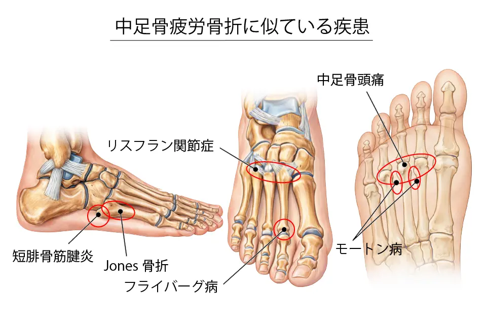 中足骨疲労骨折に似ている疾患