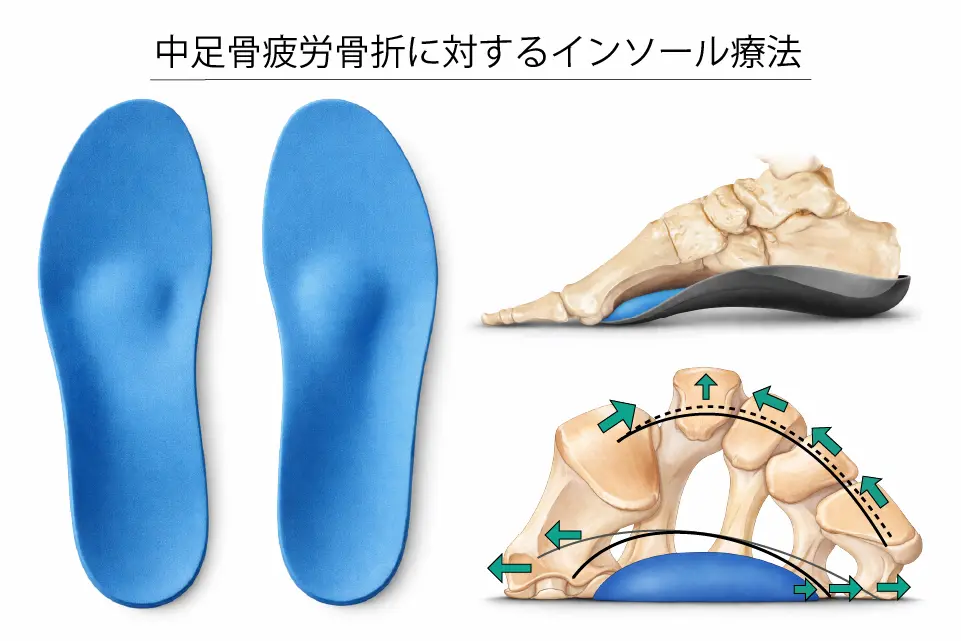 中足骨疲労骨折に対するインソール療法