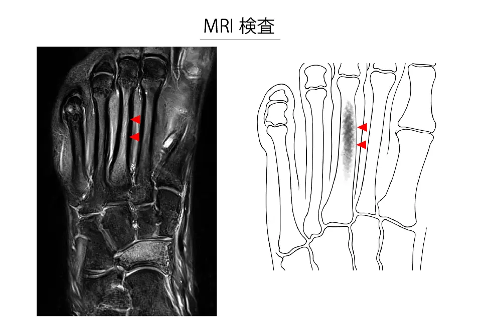 中足骨疲労骨折のMRI検査