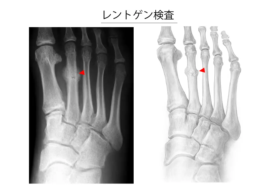 中足骨疲労骨折のレントゲン検査 (1)