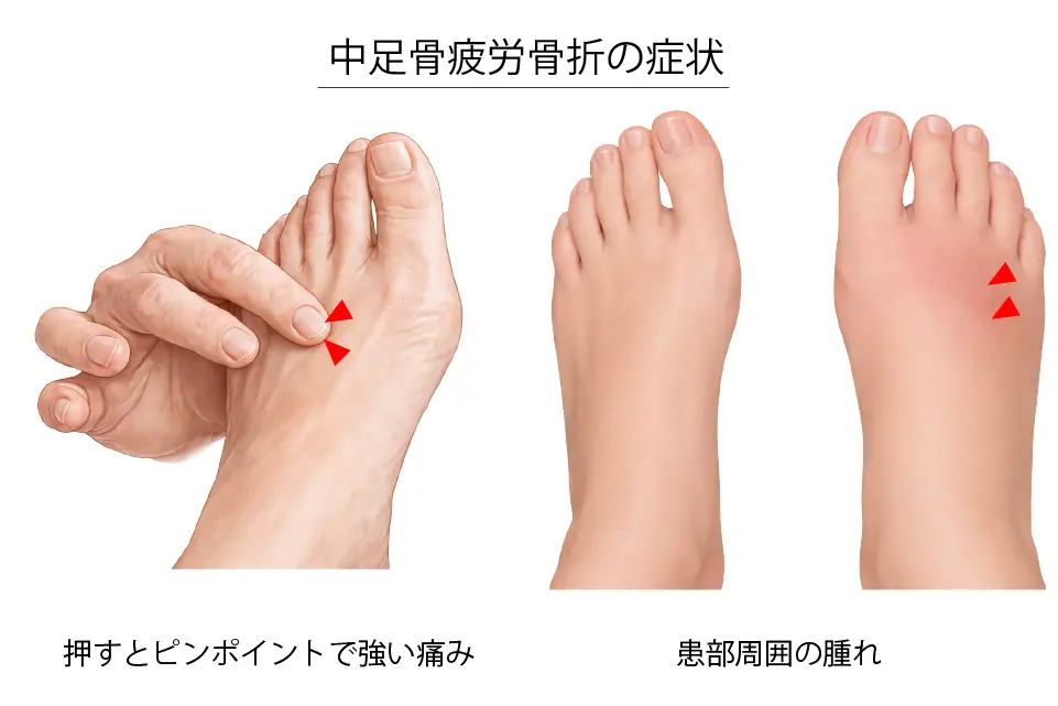 中足骨疲労骨折の症状