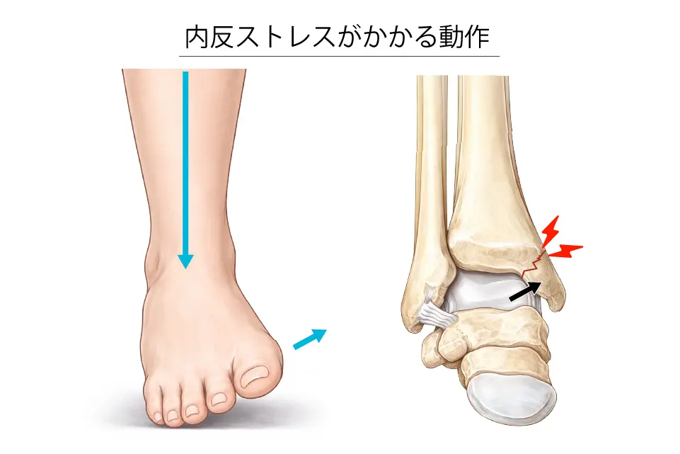 内反ストレスがかかる動作