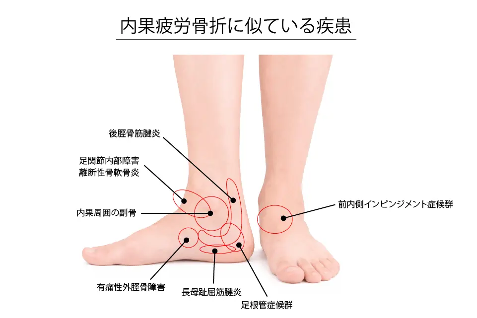 内果疲労骨折に似ている疾患
