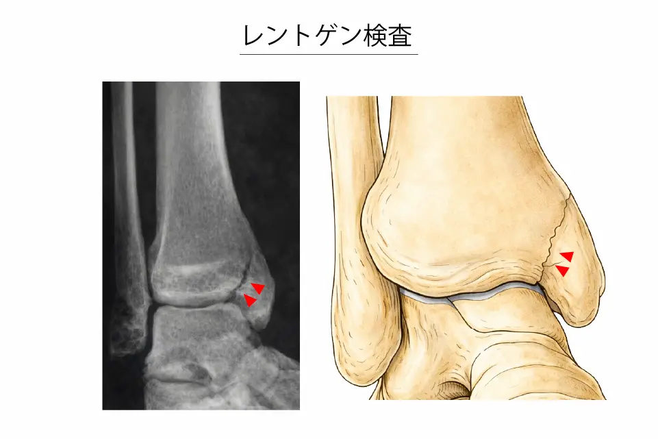 内果疲労骨折のレントゲン検査
