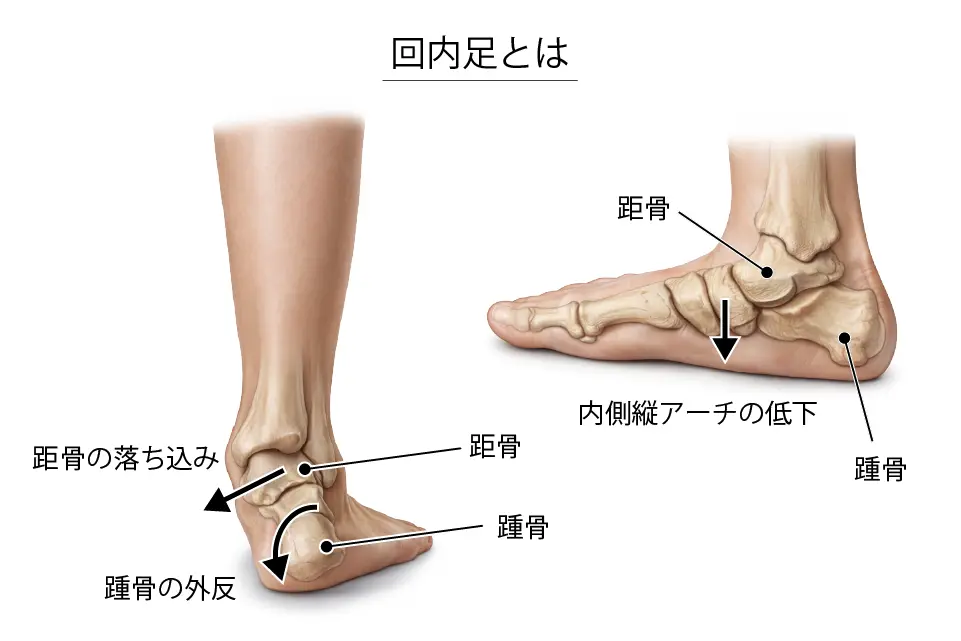 回内足とは