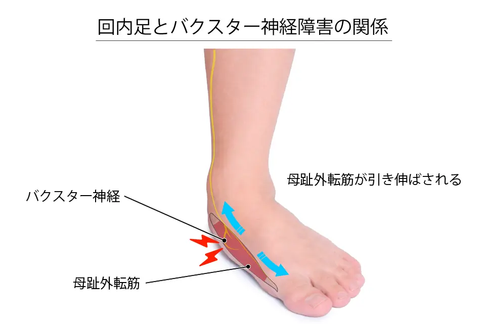 回内足とバクスター神経障害の関係