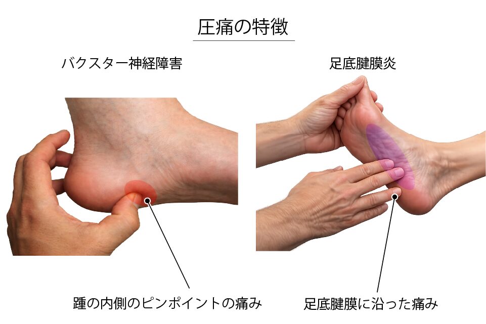 圧痛の特徴