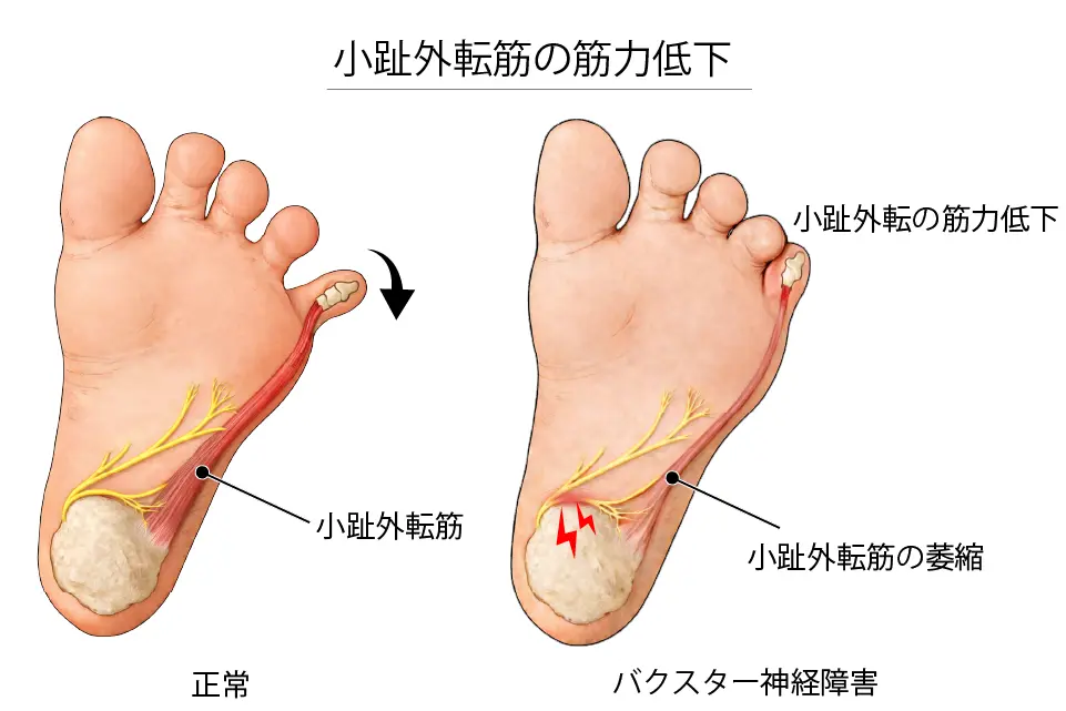 小趾外転筋の筋力低下