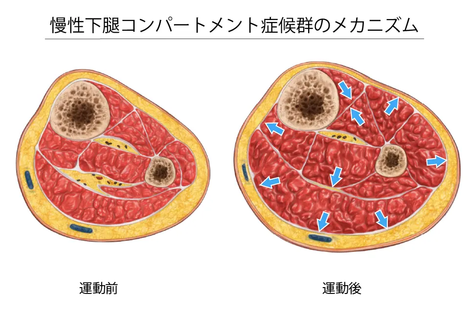 慢性下腿コンパートメント症候群のメカニズム