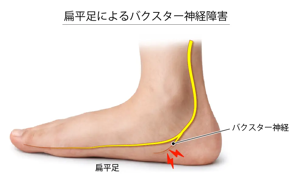 扁平足によるバクスター神経障害