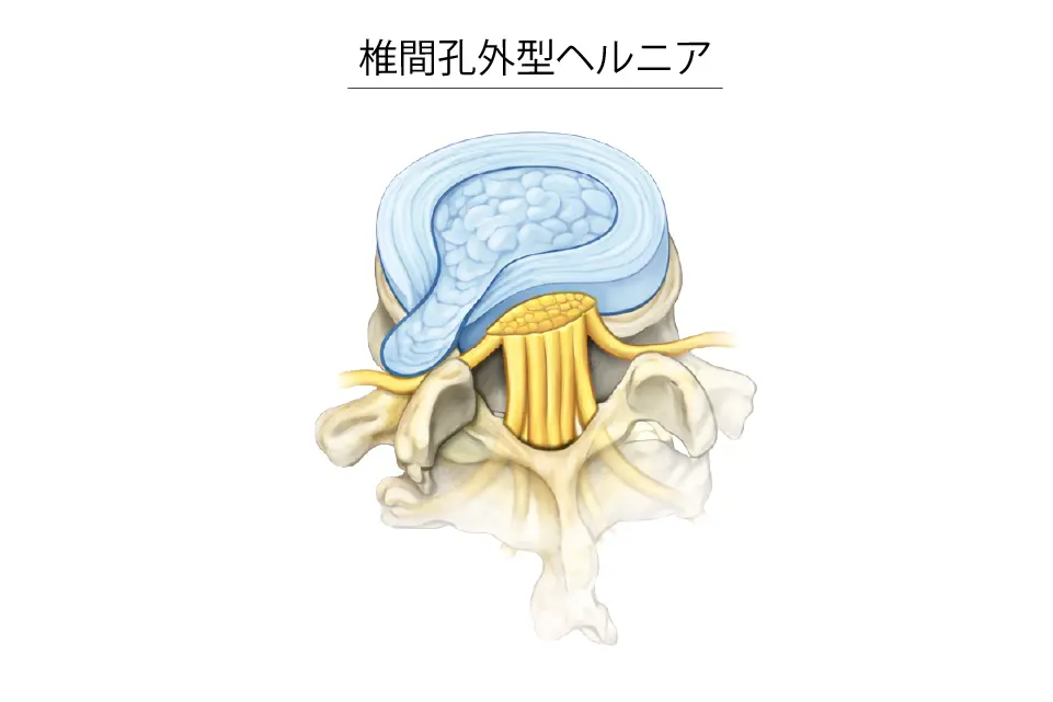 椎間孔外型ヘルニア