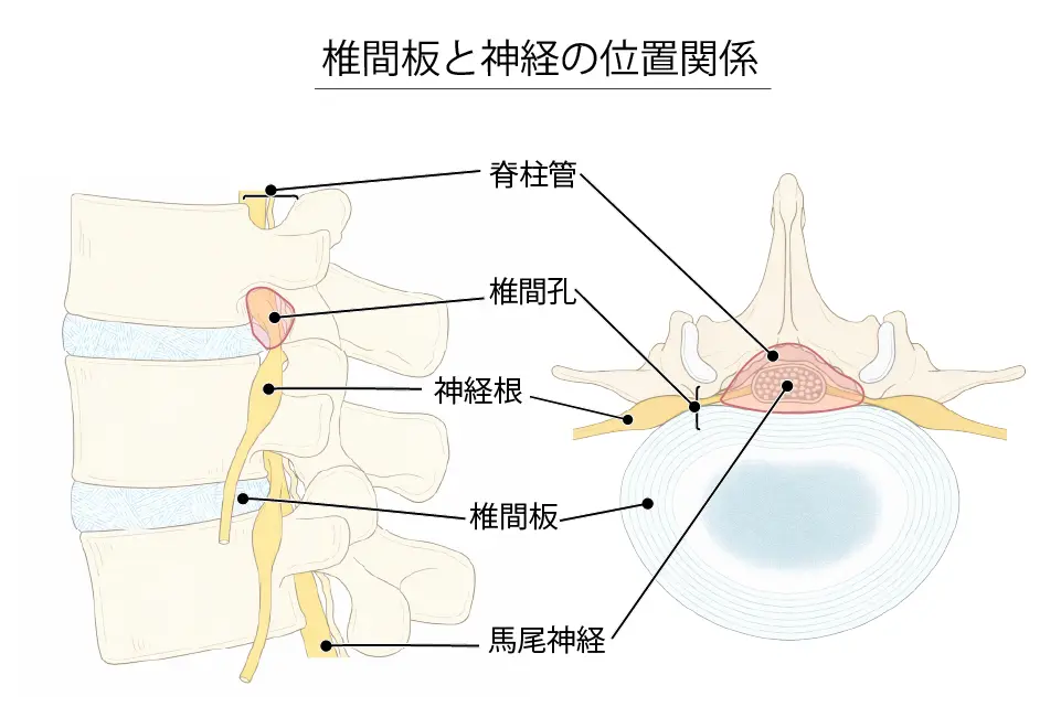 椎間板と神経の位置関係