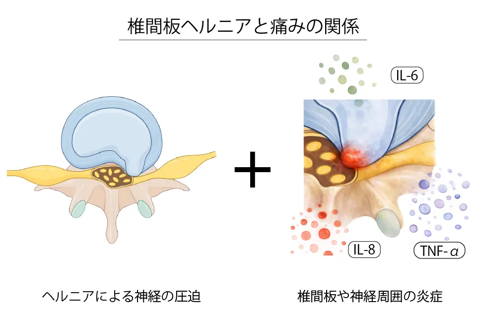 椎間板ヘルニアと痛みの関係 (1)