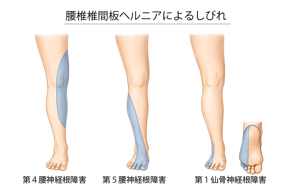 椎間板ヘルニアによるしびれ