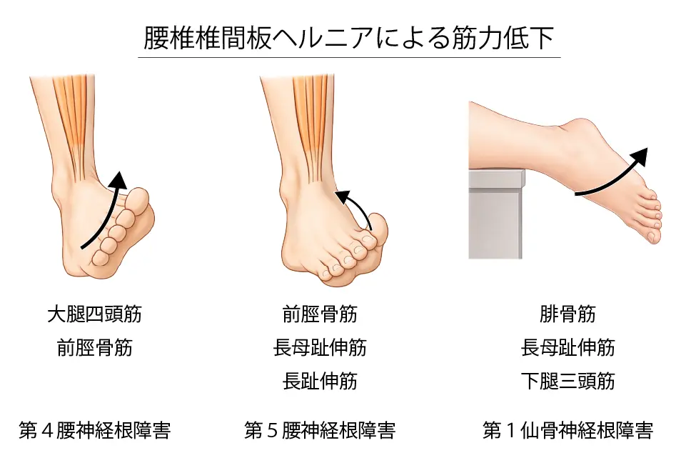 椎間板ヘルニアによる筋力低下