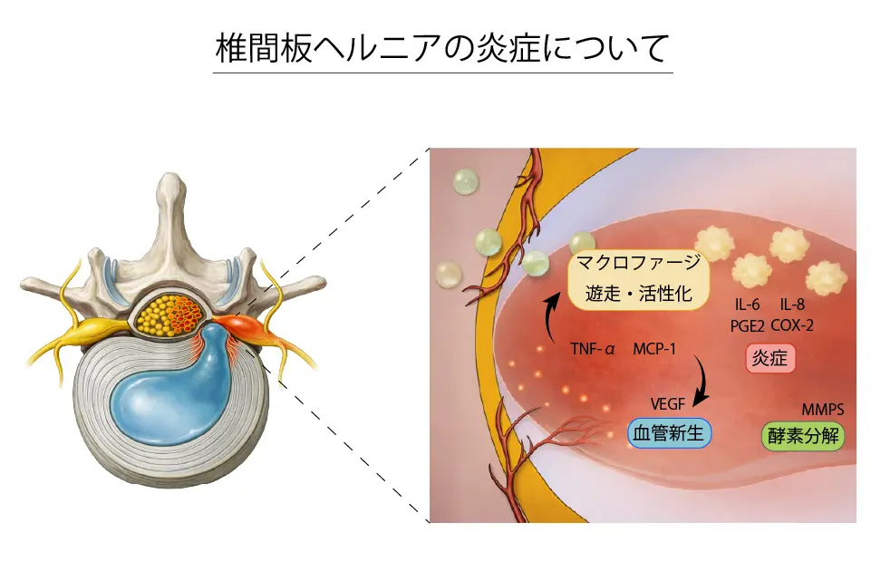 椎間板ヘルニアの炎症について