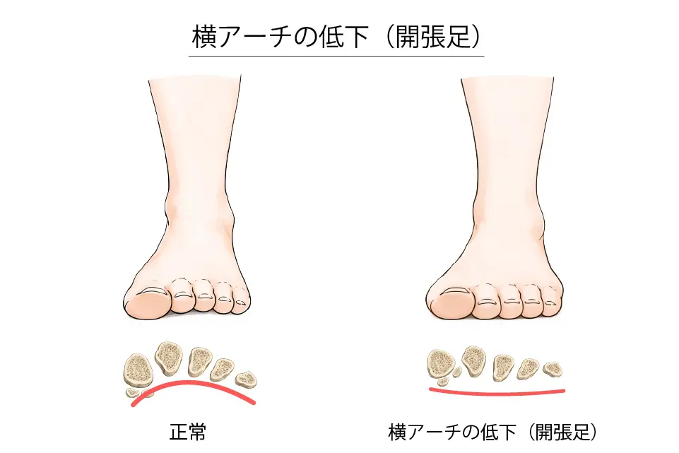 横アーチの低下（開張足）