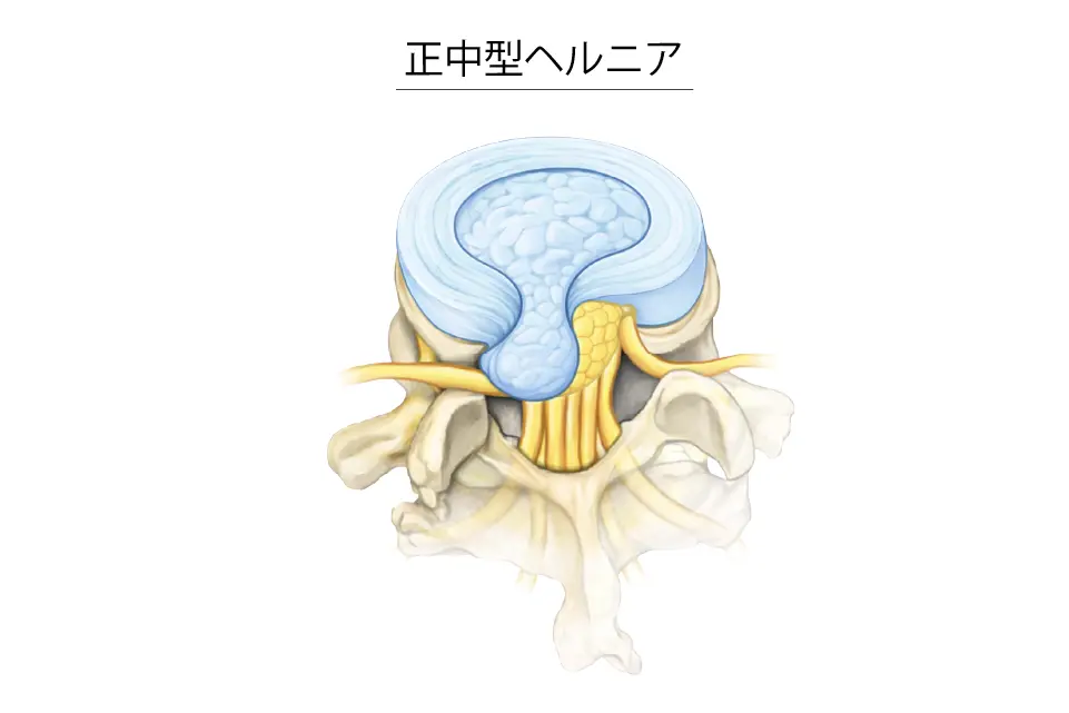 正中型ヘルニア