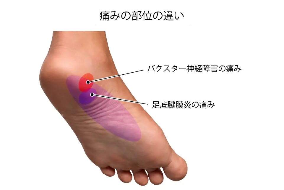 痛みの部位の違い