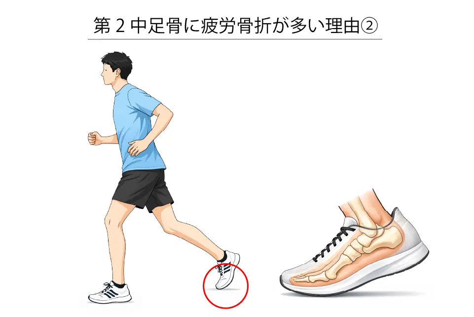 第２中足骨に疲労骨折が多い理② (1)