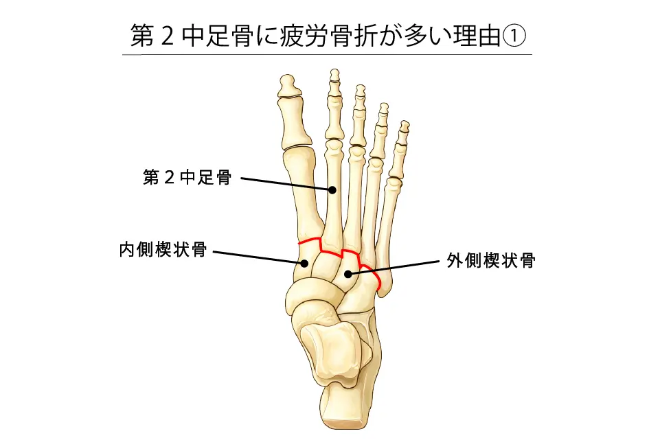 第２中足骨に疲労骨折が多い理由①