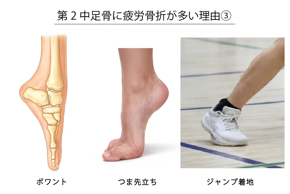 第２中足骨に疲労骨折が多い理由③