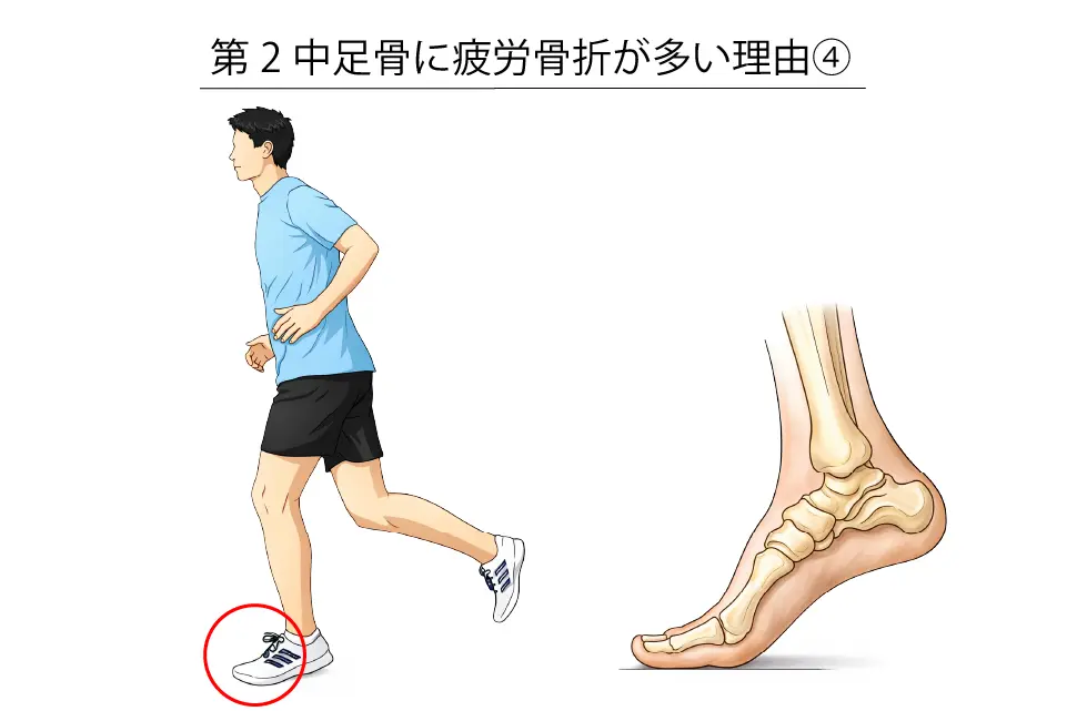 第２中足骨に疲労骨折が多い理由④ (1)