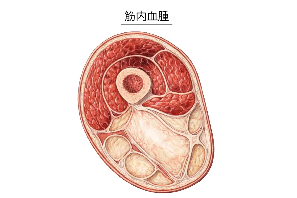 筋肉内に血腫