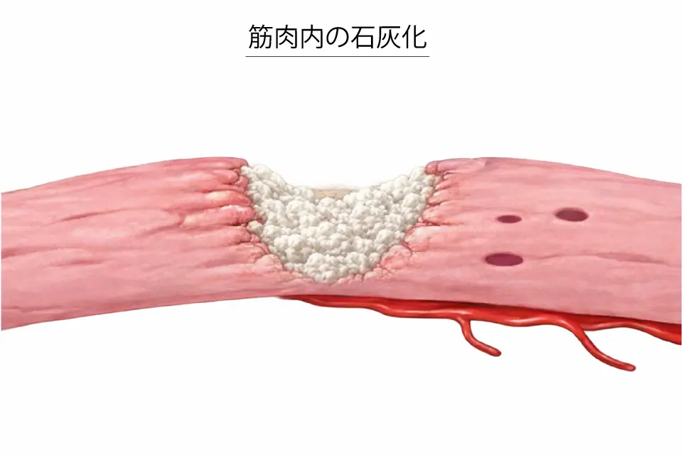 筋肉内の石灰化