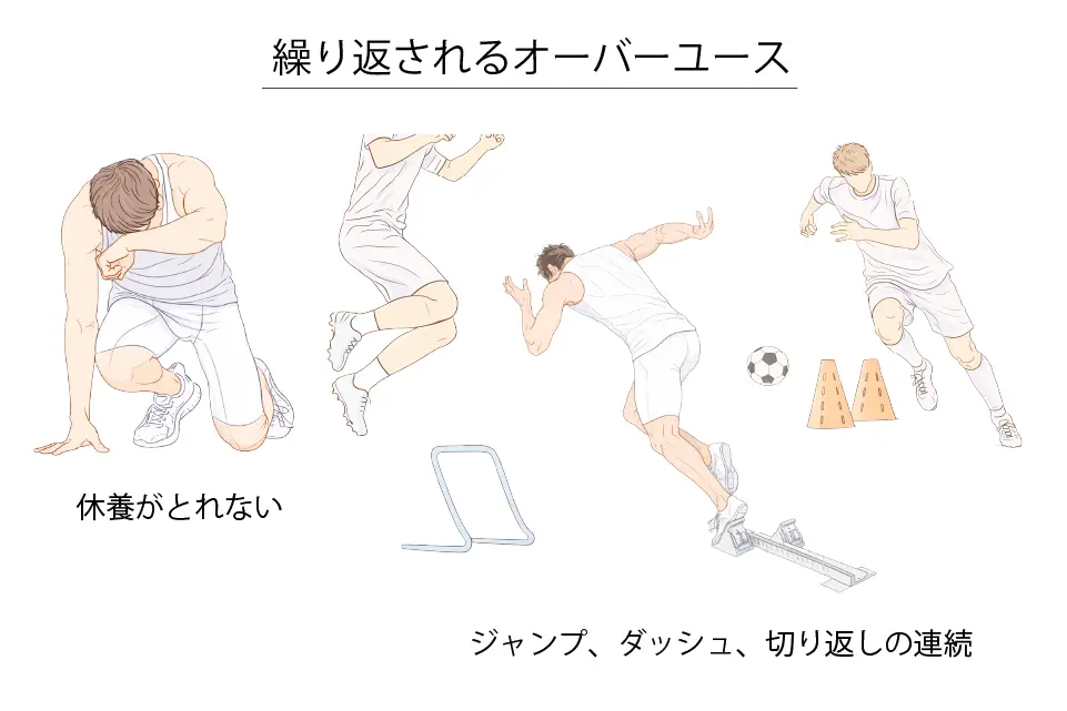 繰り返されるオーバーユース