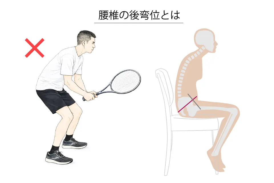 腰椎の後弯位とは