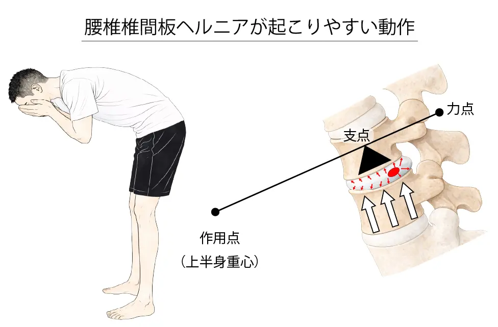 腰椎椎間板ヘルニアが起こりやすい動作