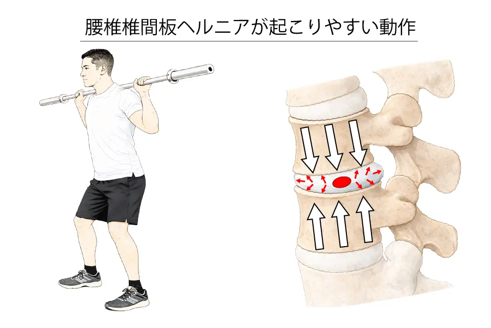 腰椎椎間板ヘルニアが起こりやすい動作２