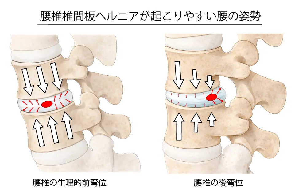 腰椎椎間板ヘルニアが起こりやすい腰の姿勢 (1)
