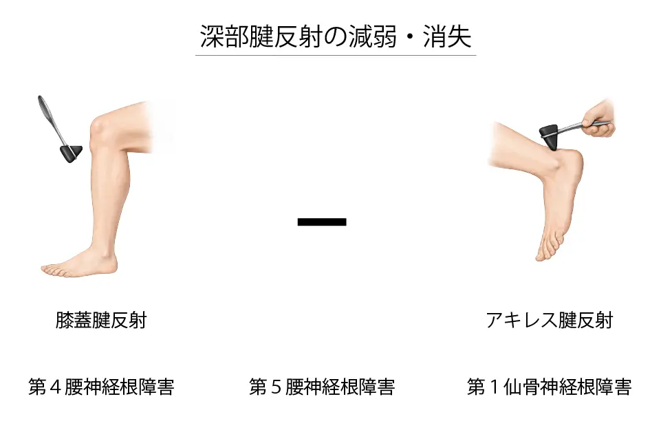 腰椎椎間板ヘルニアと深部腱反射