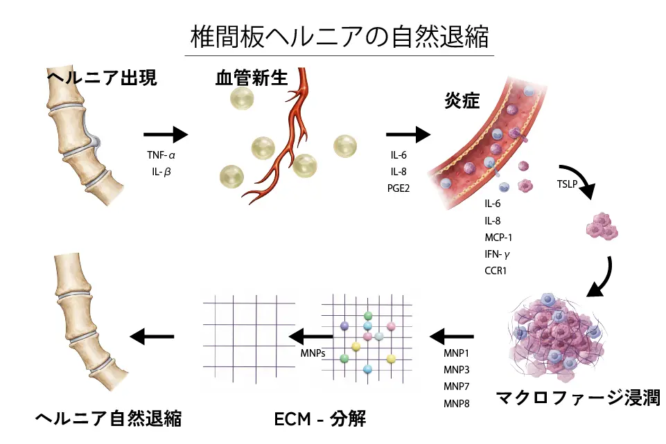 腰椎椎間板ヘルニアの自然退縮